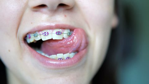 Bracefaced pigtailed teen with braces