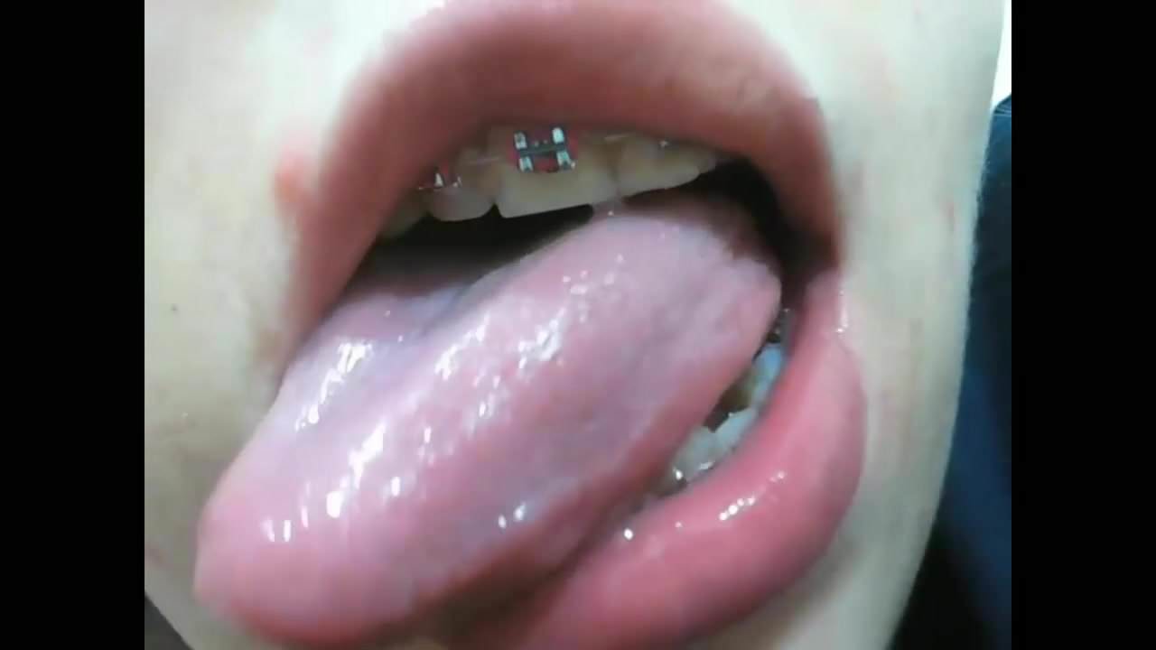 Braces tongue piercing vore
